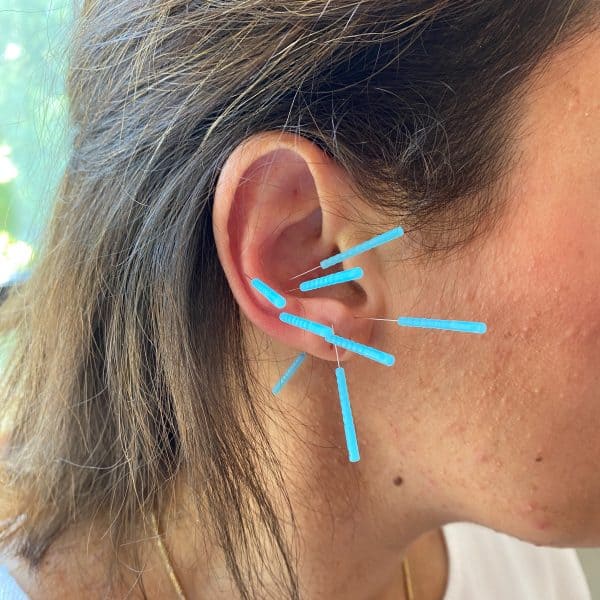 Akupunktur, Ohrakupunktur, Ear acupuncture