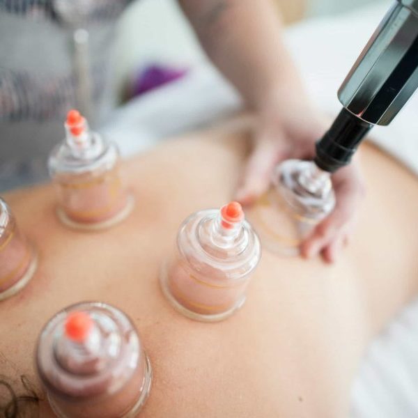 Schröpfen, Schröpfmassage, cupping